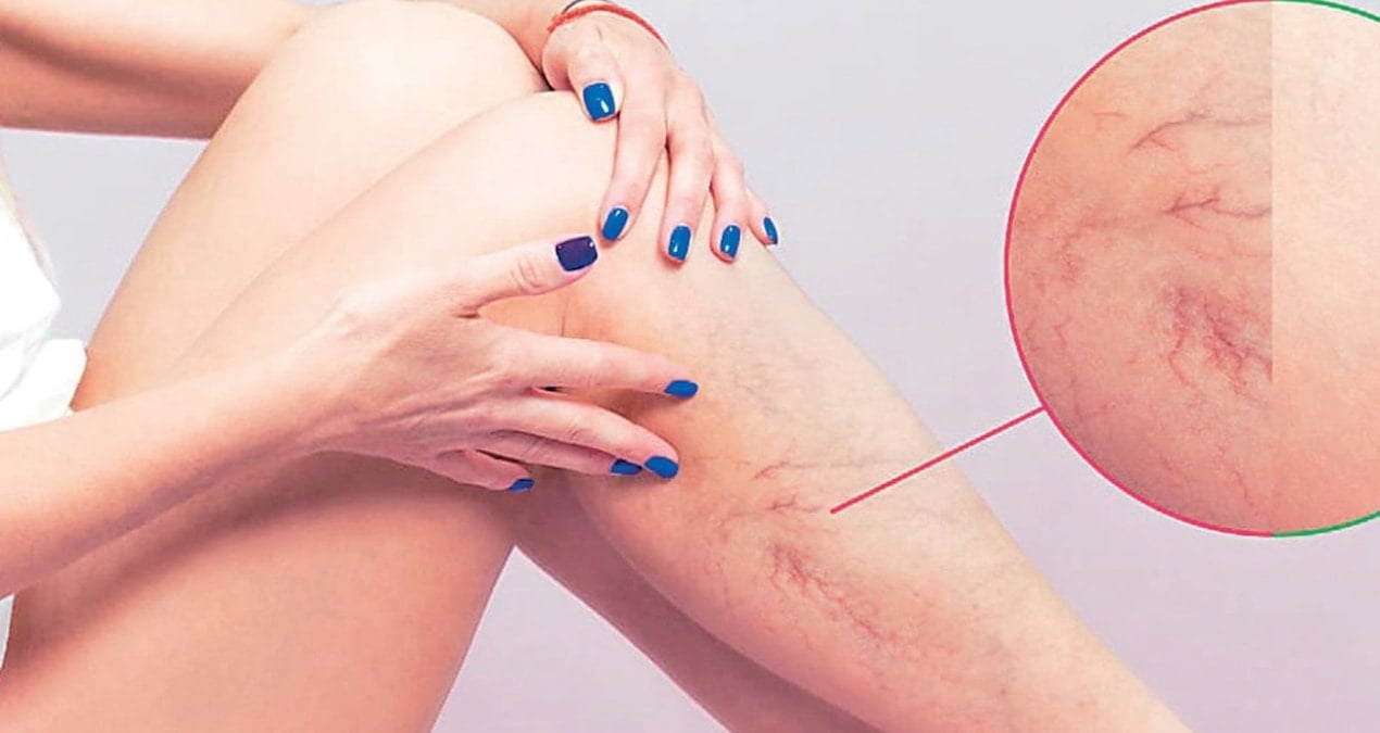 varis vucutta pihti riskini artirabilir 6OjS1rKc.jpg